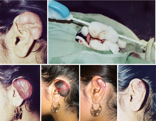 3 Crioterapia evidencia y aplicaciones