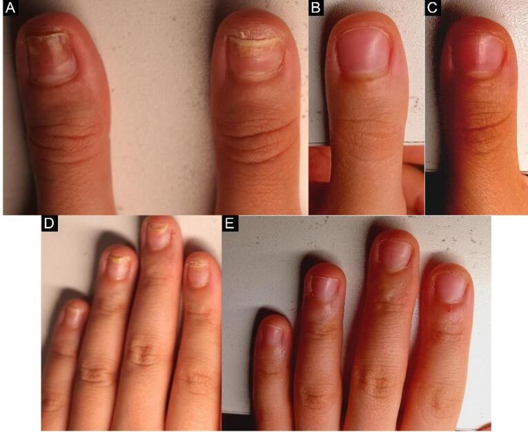 3 Nuevas tecnologías láser para psoriasis ungueal