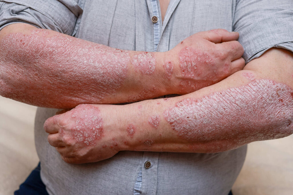 3 Psoriasis actualización europea manejo sistémico