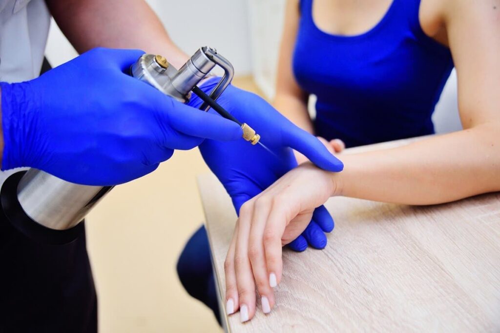 4 Crioterapia en dermatología indicaciones