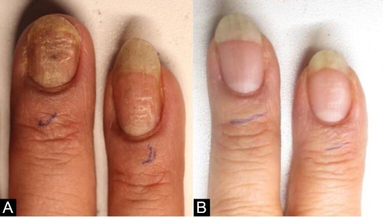 4 Nuevas tecnologías láser para psoriasis ungueal