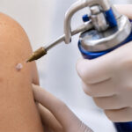 0 Crioterapia en dermatología indicaciones