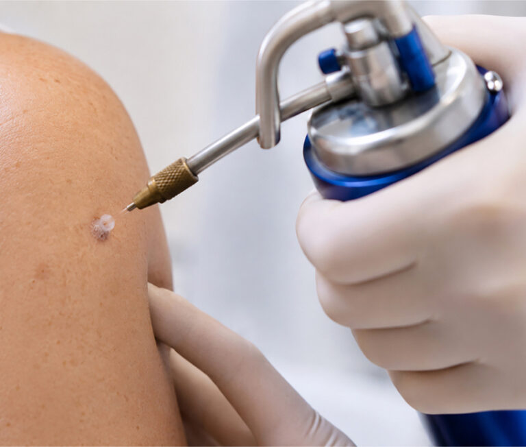 0 Crioterapia en dermatología indicaciones