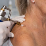 0 Crioterapia mecanismo de accion en dermatologia