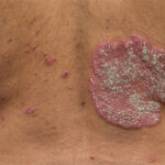 0 Fenotipos inmunológicos en psoriasis y dermatitis atópica