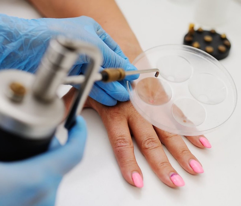 1 Crioterapia dermatología beneficios lesiones