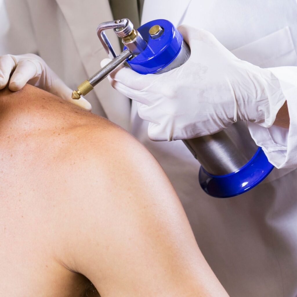 2 Crioterapia dermatología beneficios lesiones