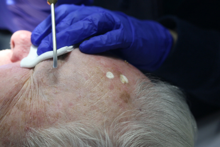 2 Crioterapia mecanismo de acción en dermatología
