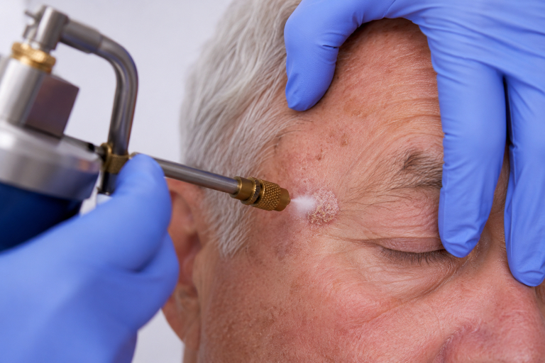 3 Crioterapia mecanismo de acción en dermatología