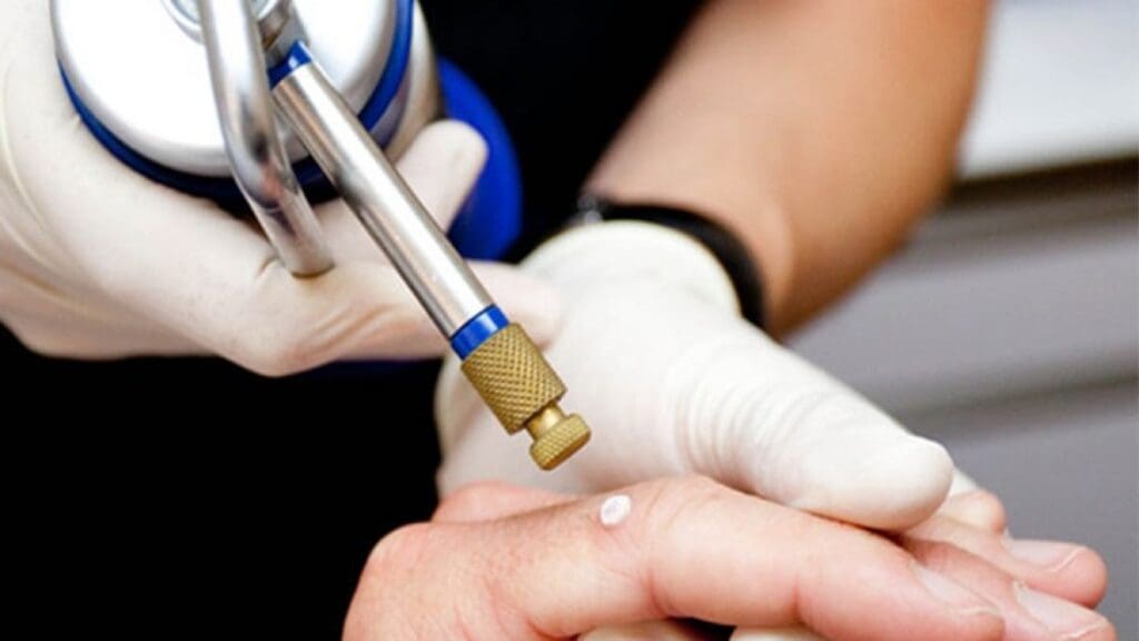 4 Crioterapia dermatología beneficios lesiones