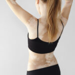 0 Vitiligo extenso nuevas evidencias con povorcitinib