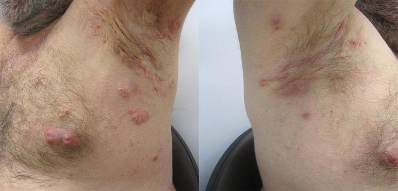 1 Hidradenitis supurativa dieta