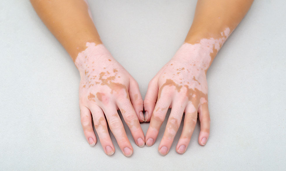 1 Vitiligo extenso nuevas evidencias con povorcitinib
