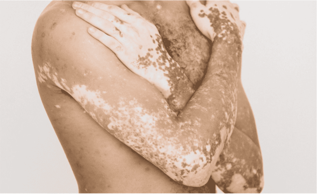 2 Vitiligo extenso nuevas evidencias con povorcitinib