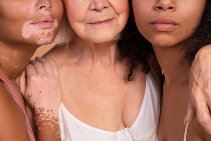 3 Vitiligo extenso nuevas evidencias con povorcitinib