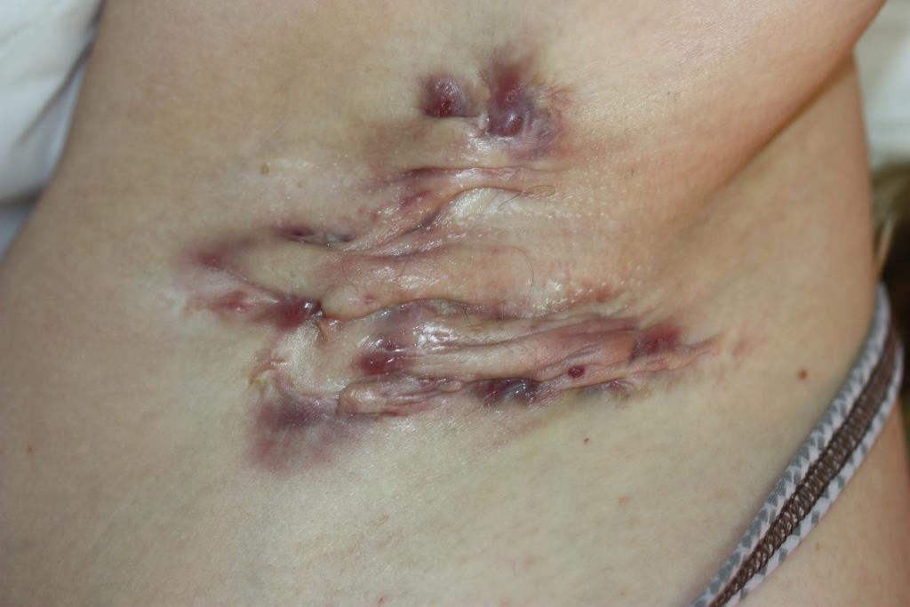 4 Hidradenitis supurativa dieta