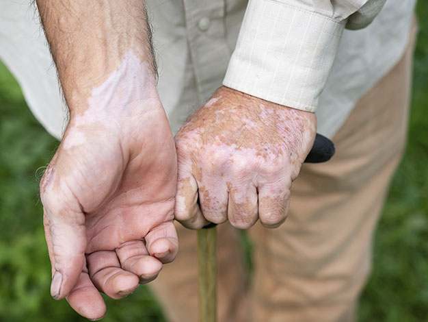 4 Vitiligo extenso nuevas evidencias con povorcitinib
