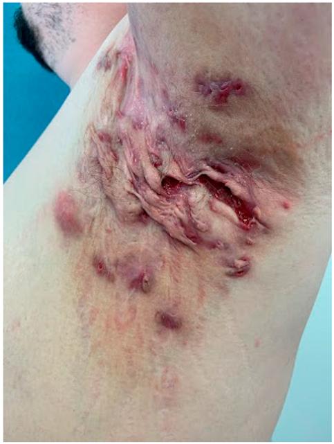 5 Hidradenitis supurativa dieta