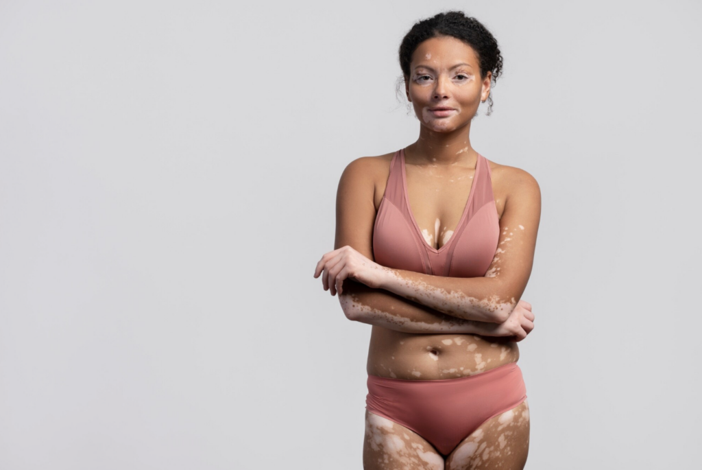 5 Vitiligo extenso nuevas evidencias con povorcitinib