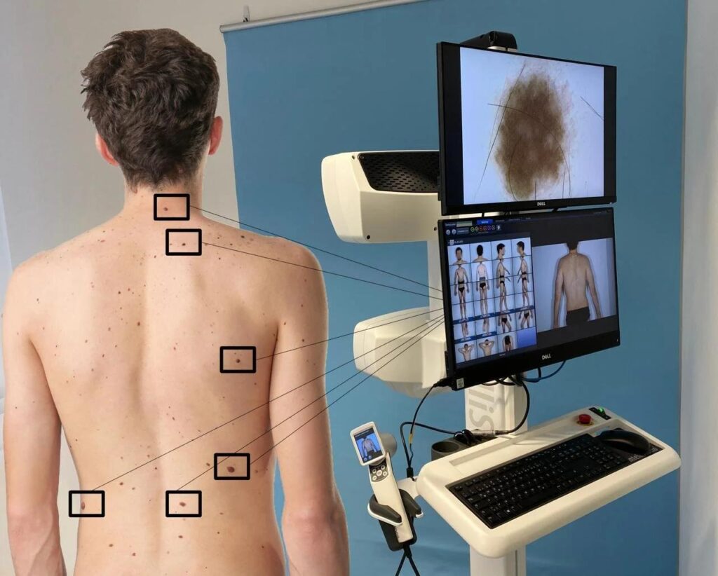 1 Melanomas células BRAF en piel aparentemente sana