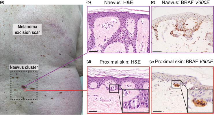 3 Melanomas células BRAF en piel aparentemente sana