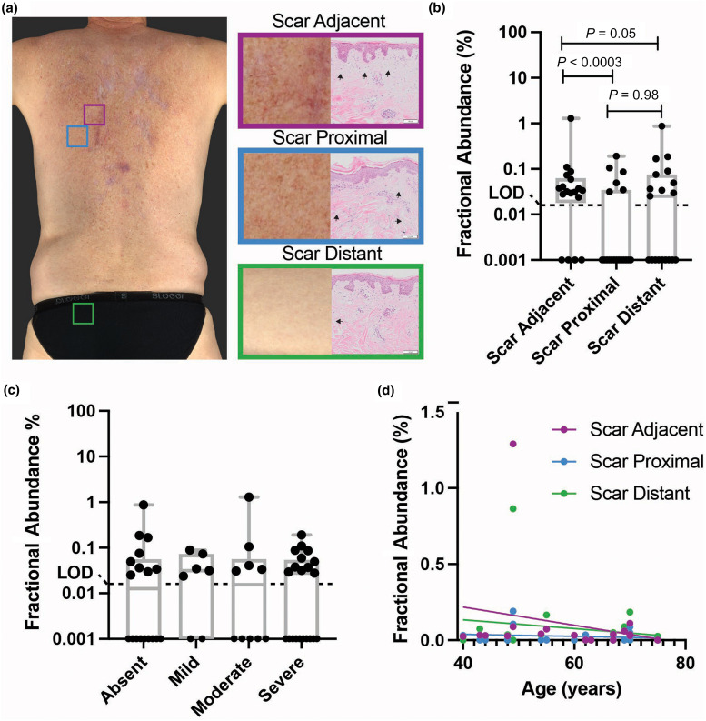 5 Melanomas células BRAF en piel aparentemente sana