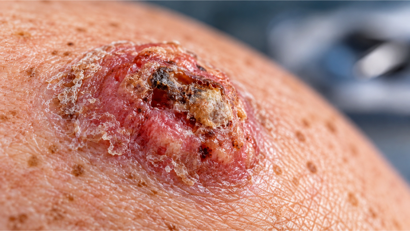 1 Carcinoma escamoso cutáneo nuevos predictores de respuesta a inmunoterapia