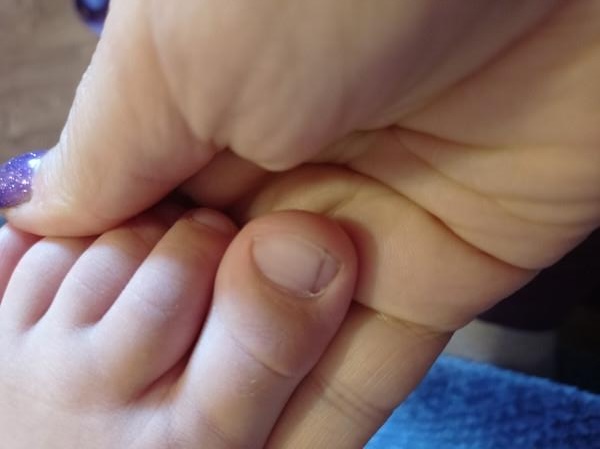 10 Trastornos ungueales en niños
